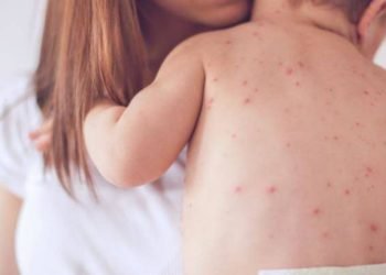 Atenție! Avocatul Poporului trage un semnal de alarmă vizavi de epidemia de rujeolă
