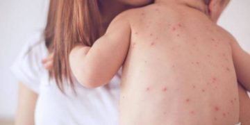 Atenție! Avocatul Poporului trage un semnal de alarmă vizavi de epidemia de rujeolă